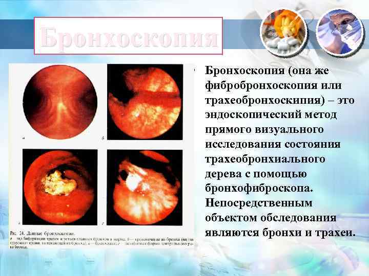Полипы трахеи и бронхов, хирургическое удаление