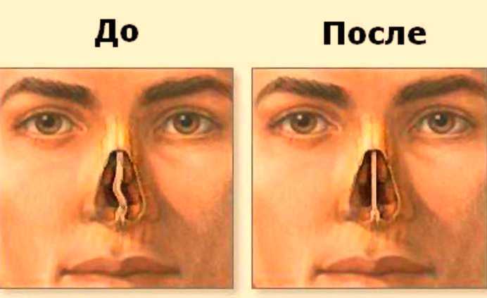 Искривление перегородки носа