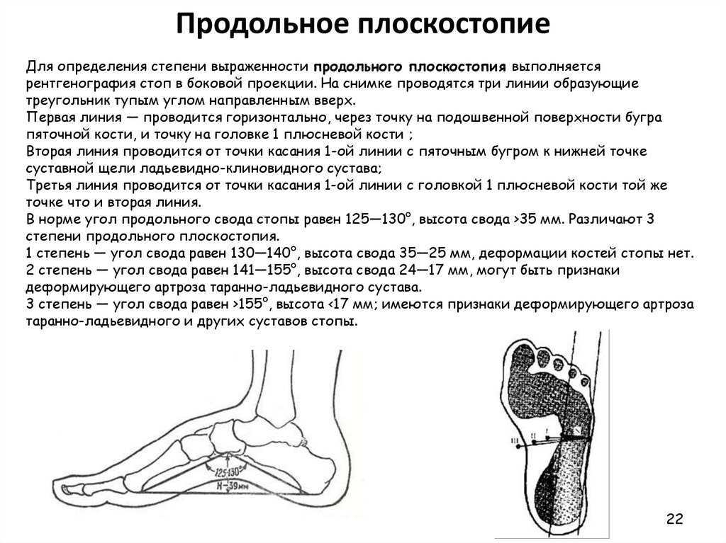 Плоскостопие: причины, диагностика, лечение