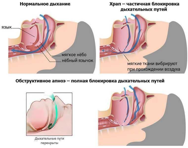 Синдром обструктивного апноэ сна