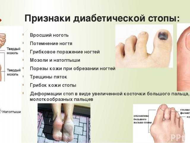 Вросший ноготь. причины, симптомы, диагностика и лечение вросшего ногтя.