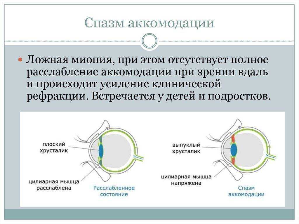 Гимнастика для глаз при катаракте - простой комплекс упражнений, йога