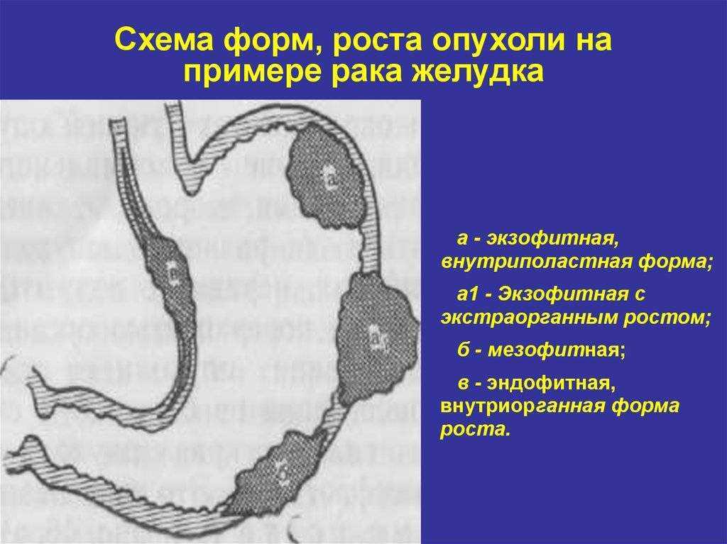Саркома мягких тканей - причины, симптомы, диагностика, лечение и профилактика