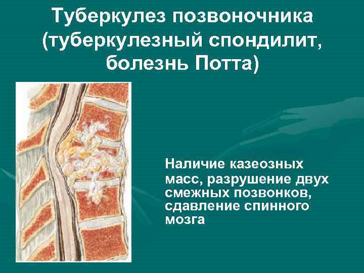 Туберкулез