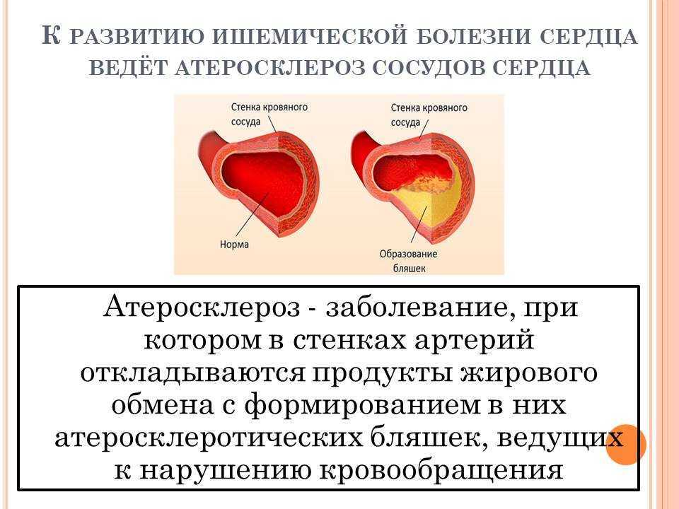 Признаки инфаркта и оказание первой помощи