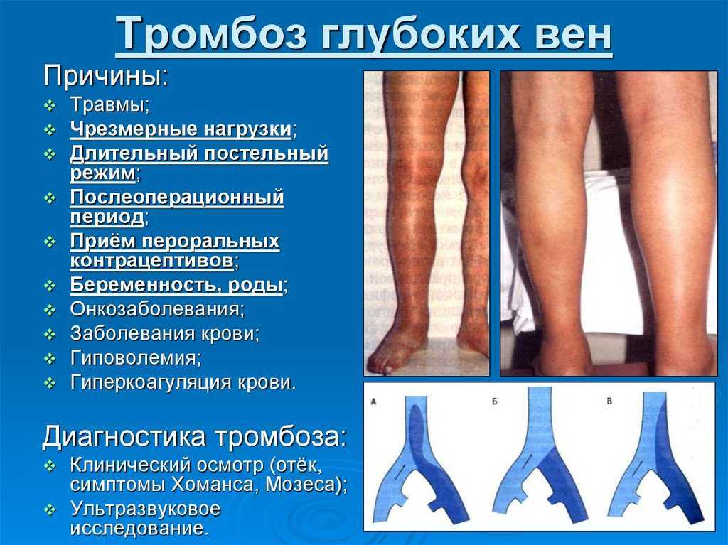 Тромбофлебит: причины, симптомы и лечение воспаления и тромбоза поверхностных вен