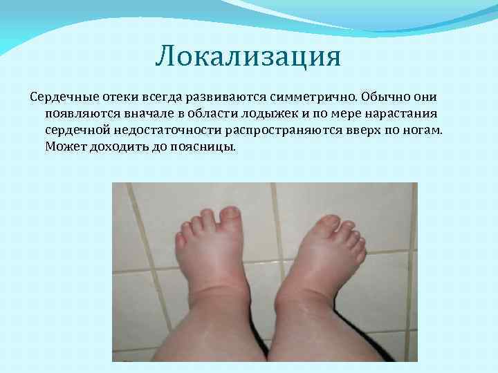 Почему появляются отеки | университетская клиника в спб