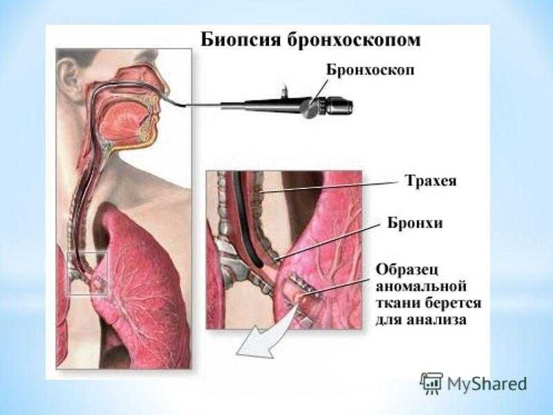 Что показывает бронхоскопия