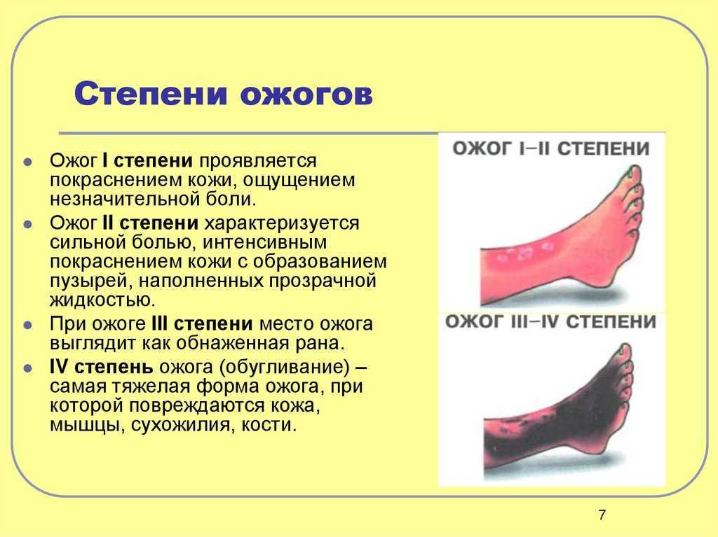 Ожог. виды, первая помощь, степени и возможные последствия