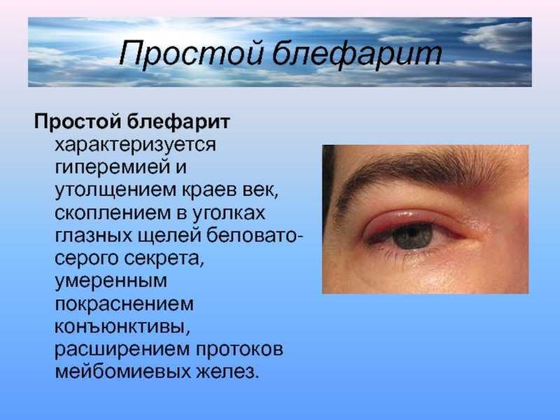Проблемы на веках глаза: причины и что делать – напоправку