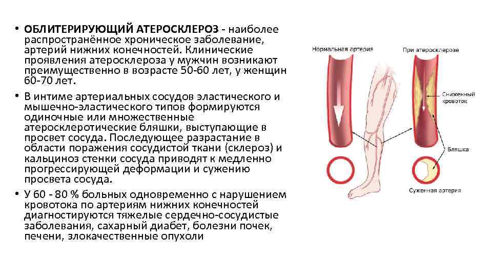 Закупорка вен на ногах, острый тромбофлебит? самое эффективное лечение тромбофлебита нижних конечностей – у нас!