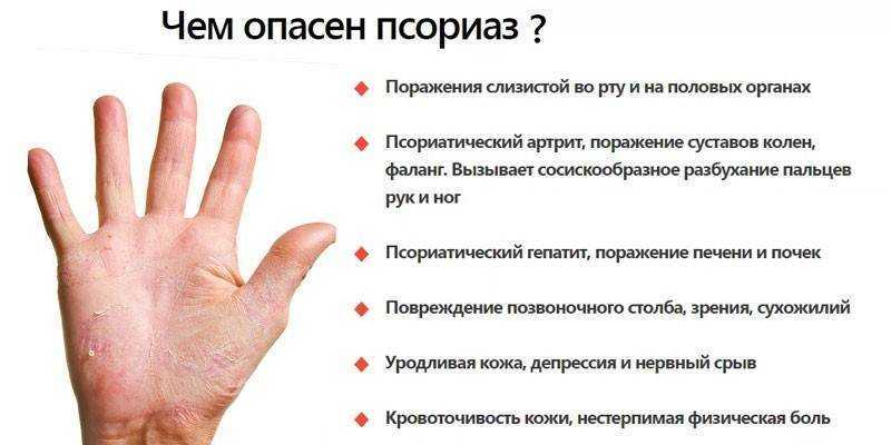 Что такое системные заболевания соединительной ткани?