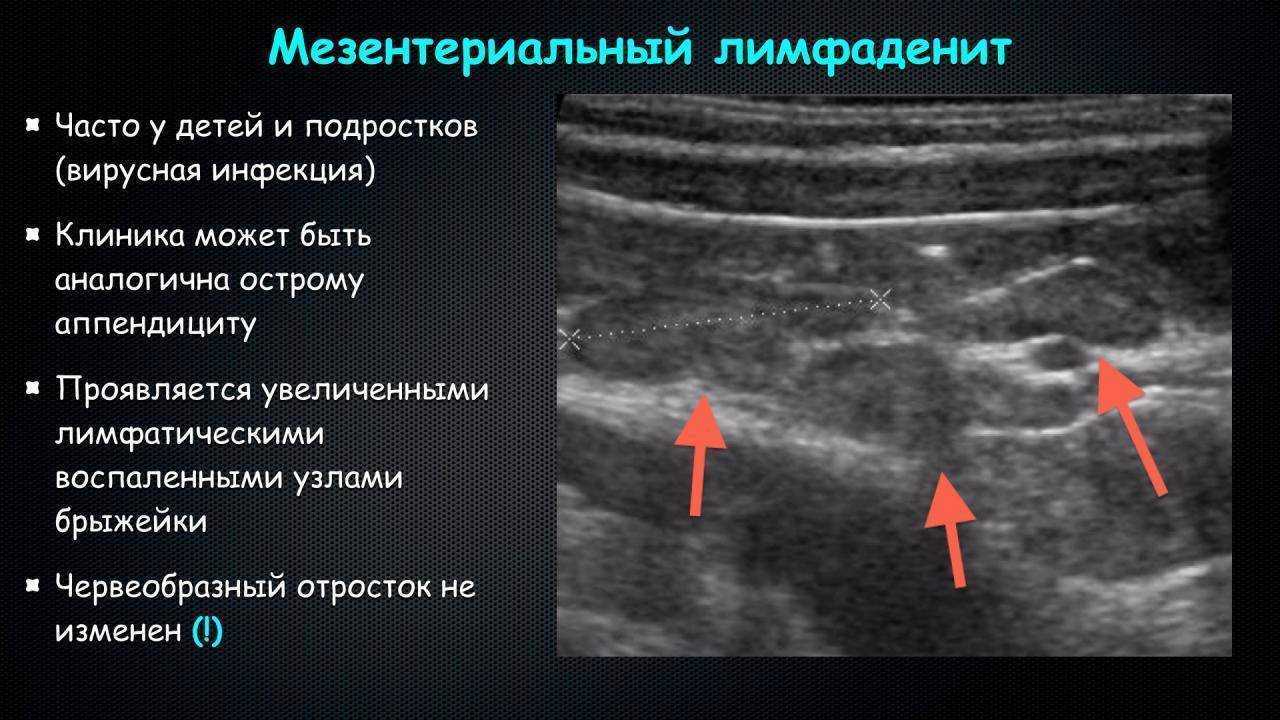 Лимфаденит: лечение, симптомы, причины, признаки