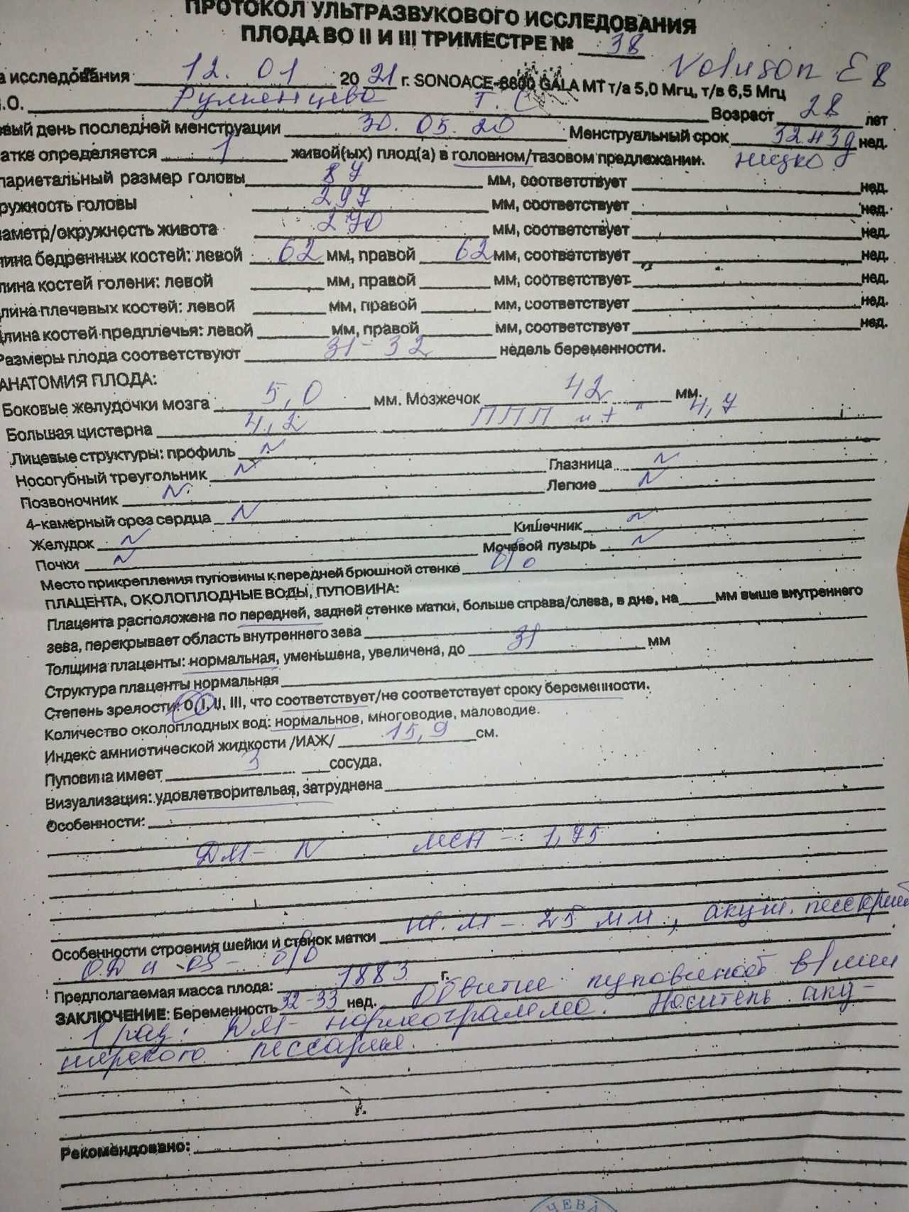Обвитие пуповины