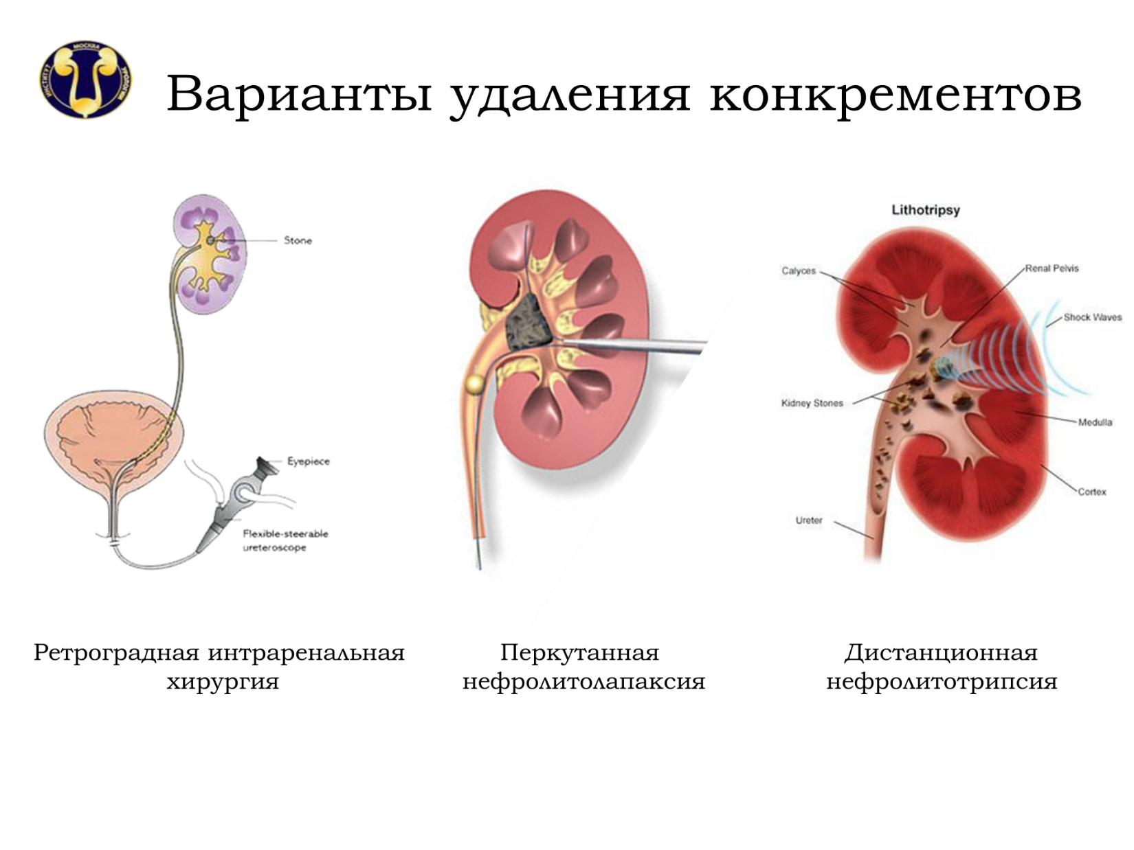 Мочекаменная болезнь