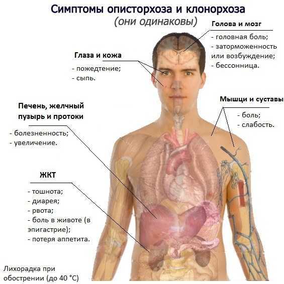 Описторхоз