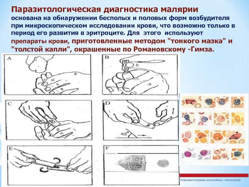 Основные методы лабораторной диагностики малярии у детей и взрослых