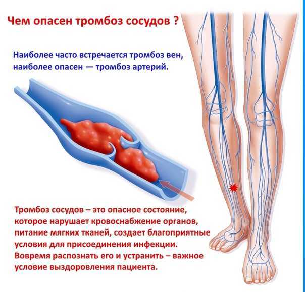 Тромбоз вен. причины, симптомы, диагностика и лечение тромбоза