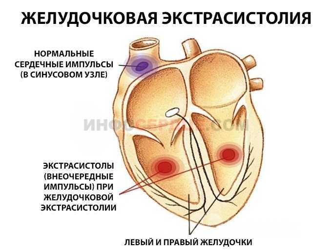 Фибрилляция и трепетание желудочков