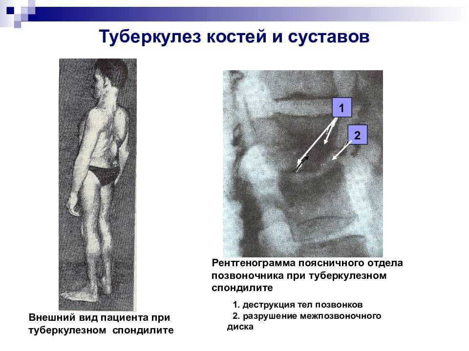 Псевдотуберкулез у детей - симптомы болезни, профилактика и лечение псевдотуберкулеза у детей, причины заболевания и его диагностика на eurolab