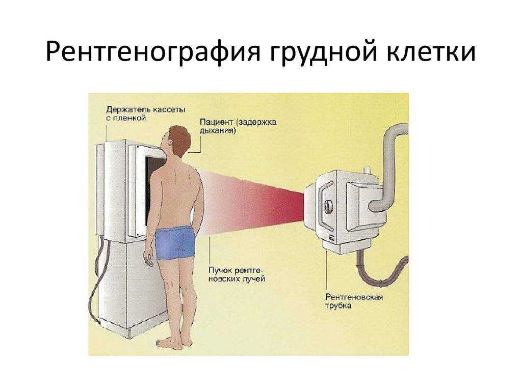 Жидкость в плевральной полости - диагностика и лечение | университетская клиника