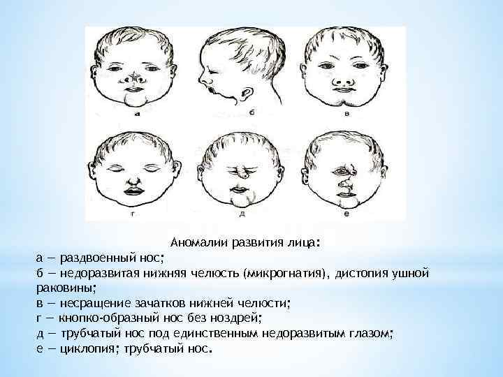 Заячья губа - признаки, причины, симптомы, лечение и профилактика - idoctor.kz