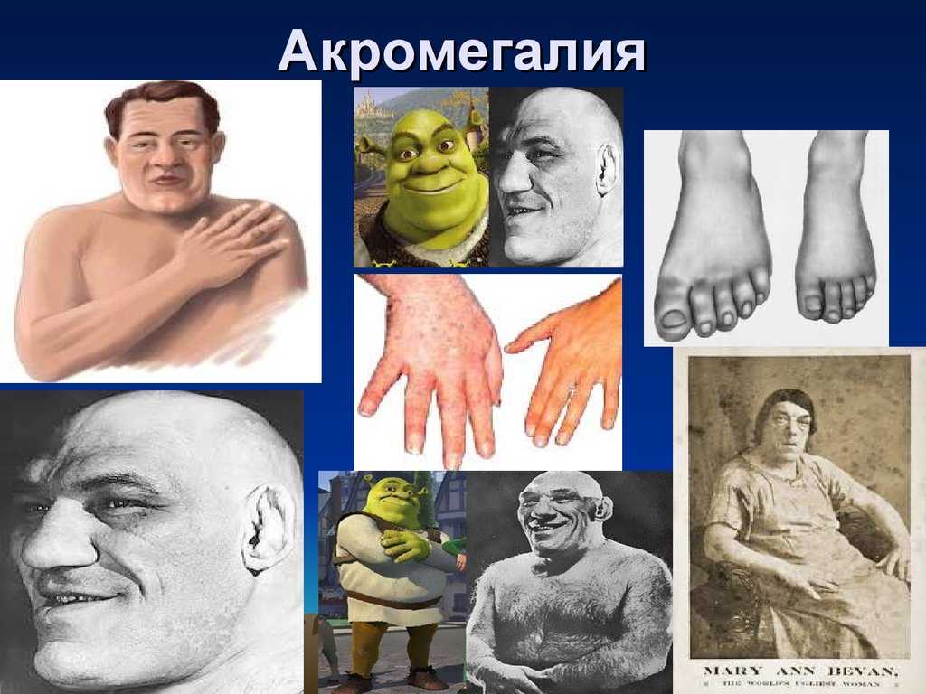 Коллагеноз -  заболевания соединительной ткани. симптомы коллагеноза. виды патологий соединительной ткани.!