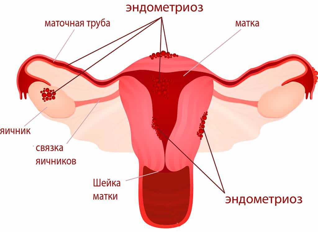 Почему возникает эндометриоз лечение эндометриоза.