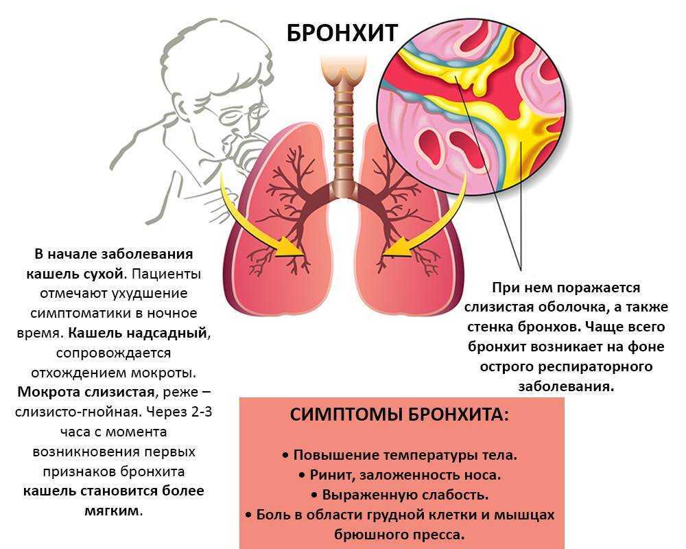 Бронхит