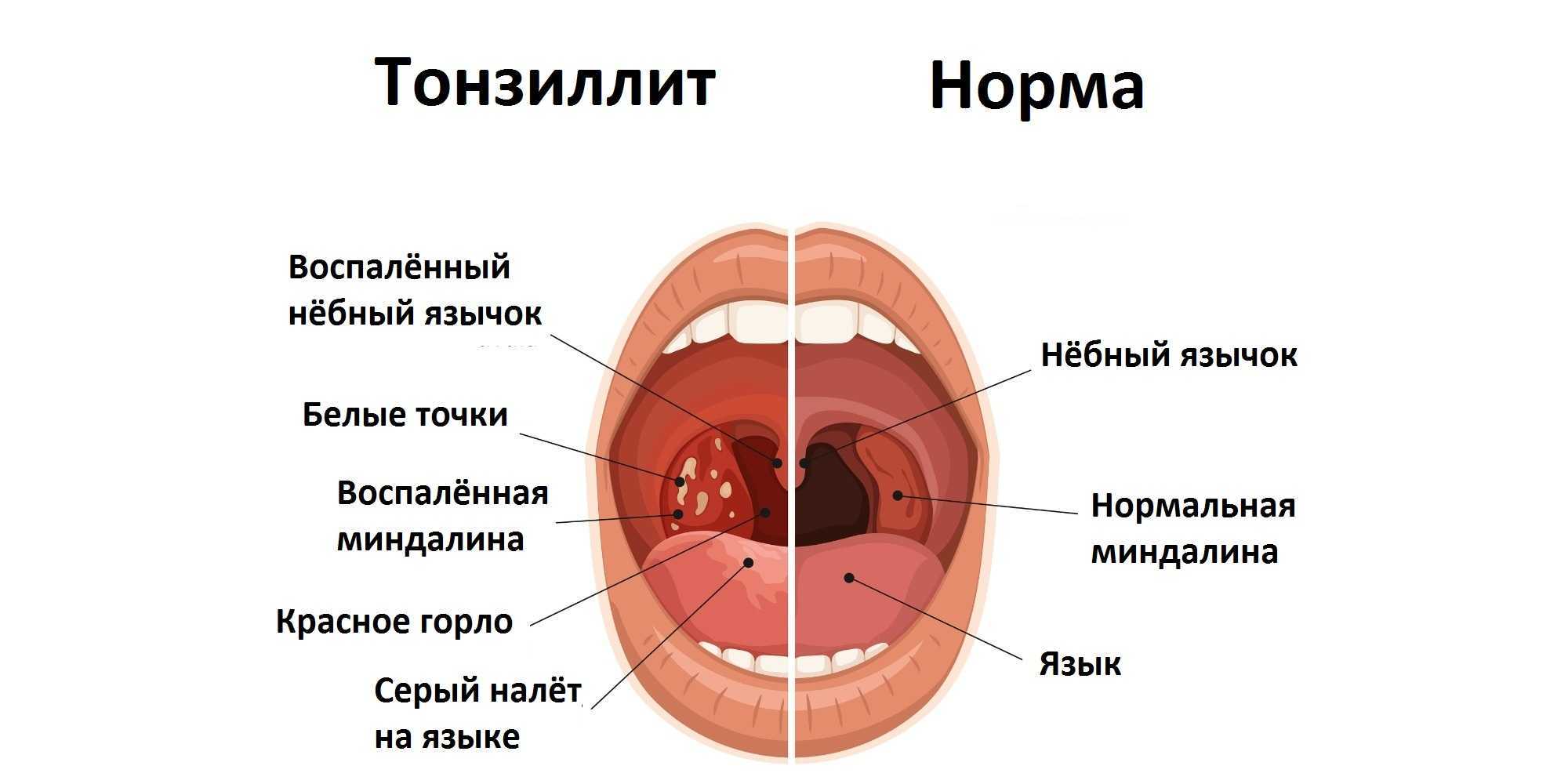 Абсцесс паратонзилярный