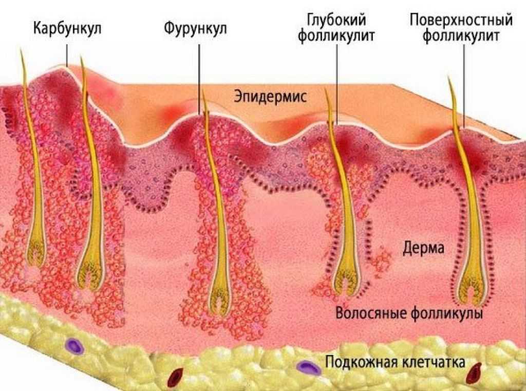 Пиодермия