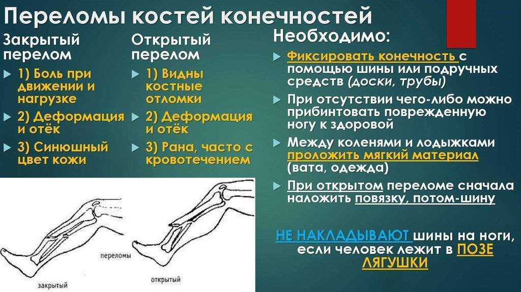 Перелом голени - виды и степени тяжести, симптомы, лечение и реабилитация. первая помощь при переломе голени