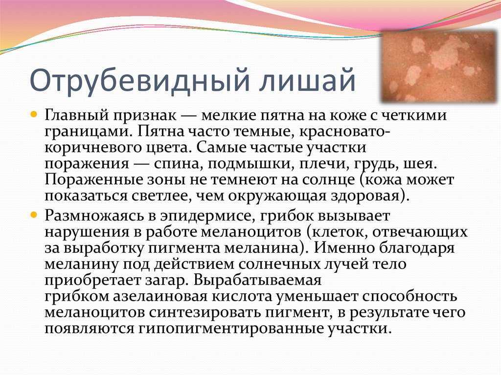 Витилиго