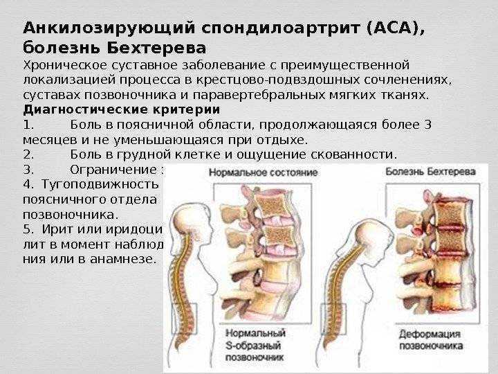 Болезнь бехтерева