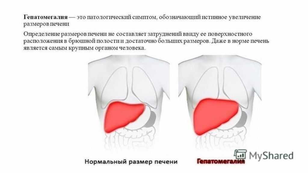 Очаговые образования печени / заболевания / клиника эксперт