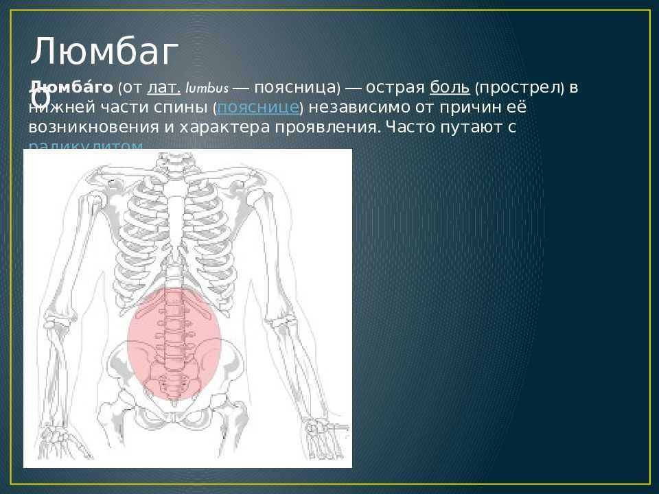Люмбаго