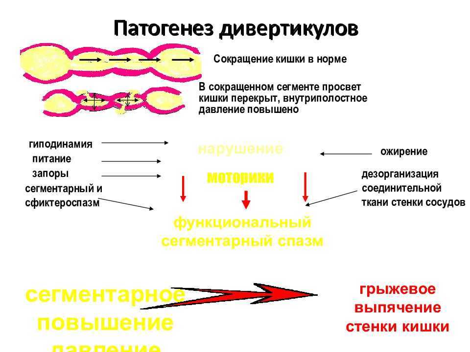 Дивертикулит. симптомы, диагностика и лечение.!