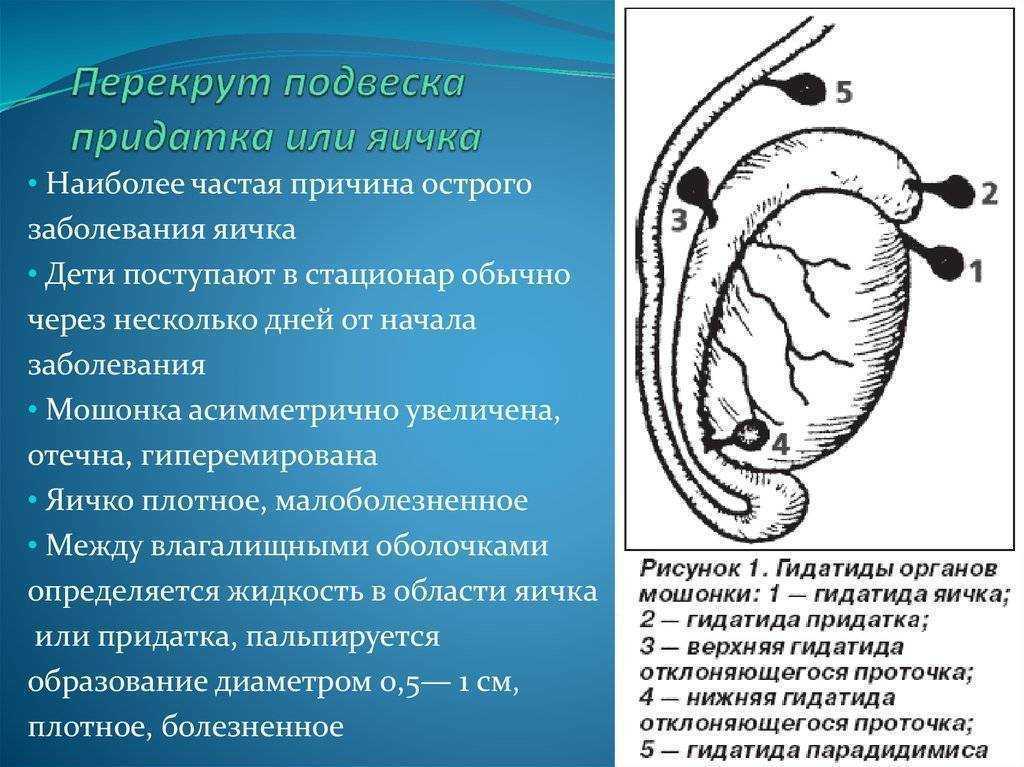 Перекрут яичка | университетская клиника