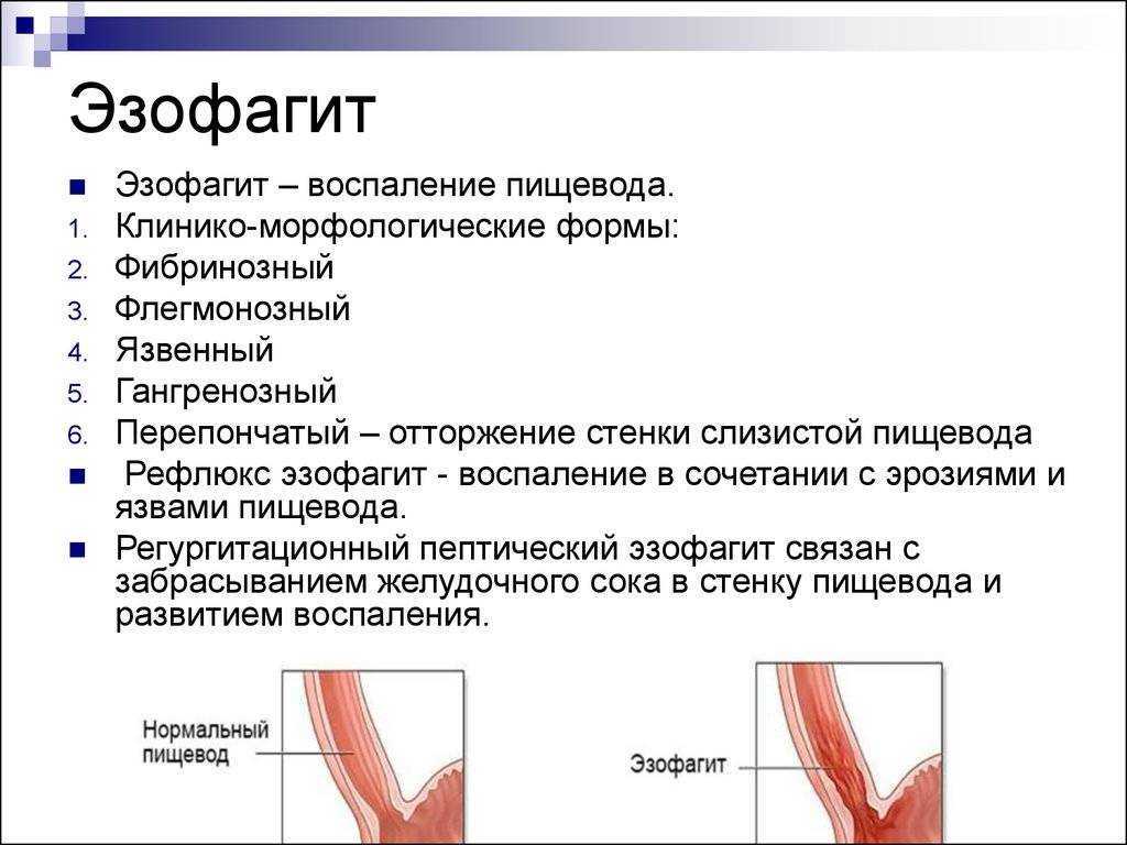 Гастроэзофагеальная рефлюксная болезнь (гэрб) - отвечаем на самые популярные вопросы.