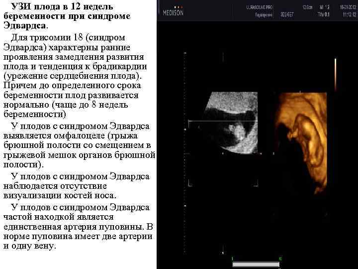 Мозаичный синдром дауна: особенности болезни и пациентов с таким диагнозом, диагностика и лечение, советы родителям