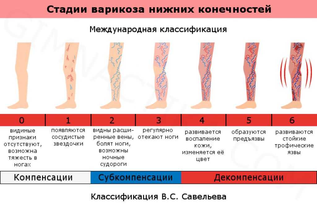 Тромбоз вен верхних конечностей — симптомы,причины,лечение