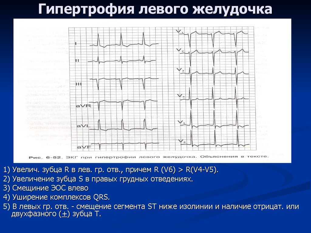 Изменения на кардиограмме при гипертрофических процессах в миокарде