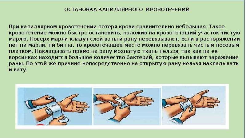 Оказание первой помощи при капиллярном и венозном кровотечениях