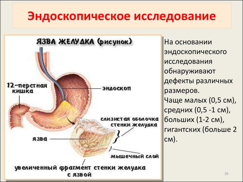 Язва желудка