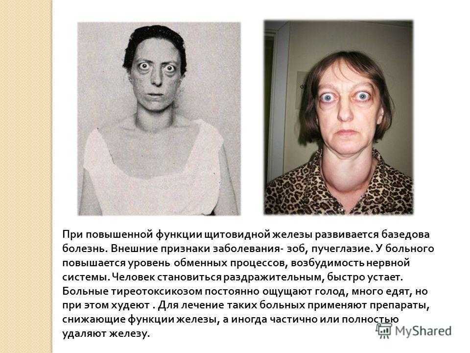 Гипертиреоз: причины, симптомы и лечение
