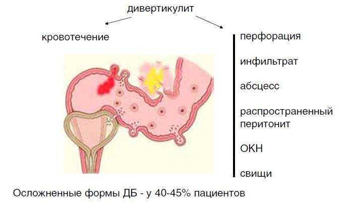 Дивертикулы толстой кишки