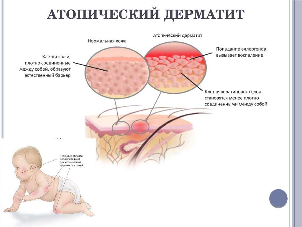 Аллергическая реакция организма на определённый раздражитель, проявляющаяся хроническими воспалительными реакциями кожи, слово дерматит означает воспаление кожного покрова, которое, в большинстве случаев, проявляется зудом, покраснением кожи и кожными выс