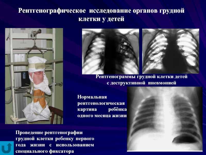 Рентген (рентгенография) органов грудной клетки обзорная — клиника «доктор рядом»