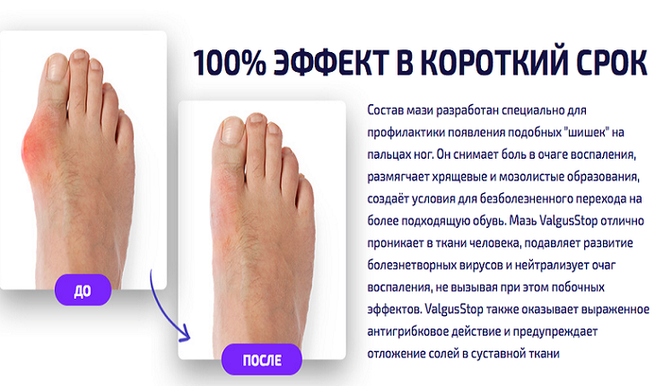 В медицине данное поражение опорно-двигательного аппарата носит название вальгусной деформации большого пальца стопы или Hallux valgus - в буквальном переводе с латыни – искривление большого пальца стопы