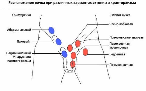Нарушение строения мошонки у мальчиков